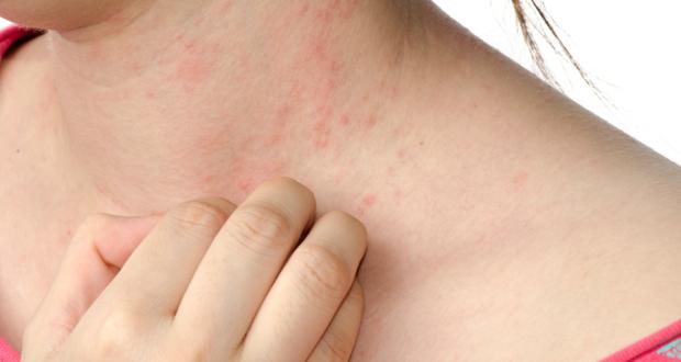 Skin-rashes